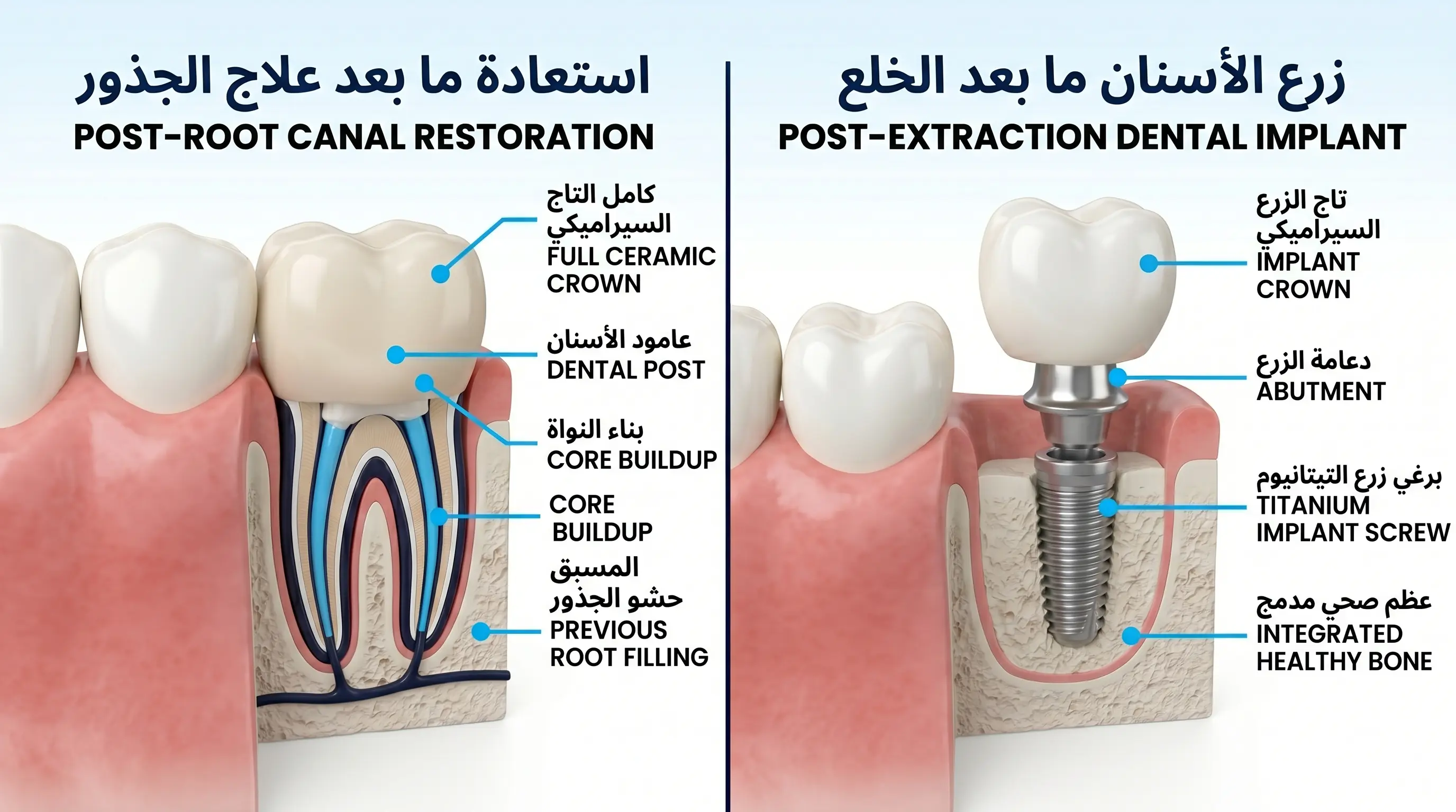 علاج العصب أم خلع السن؟ متى نختار كل منهما
