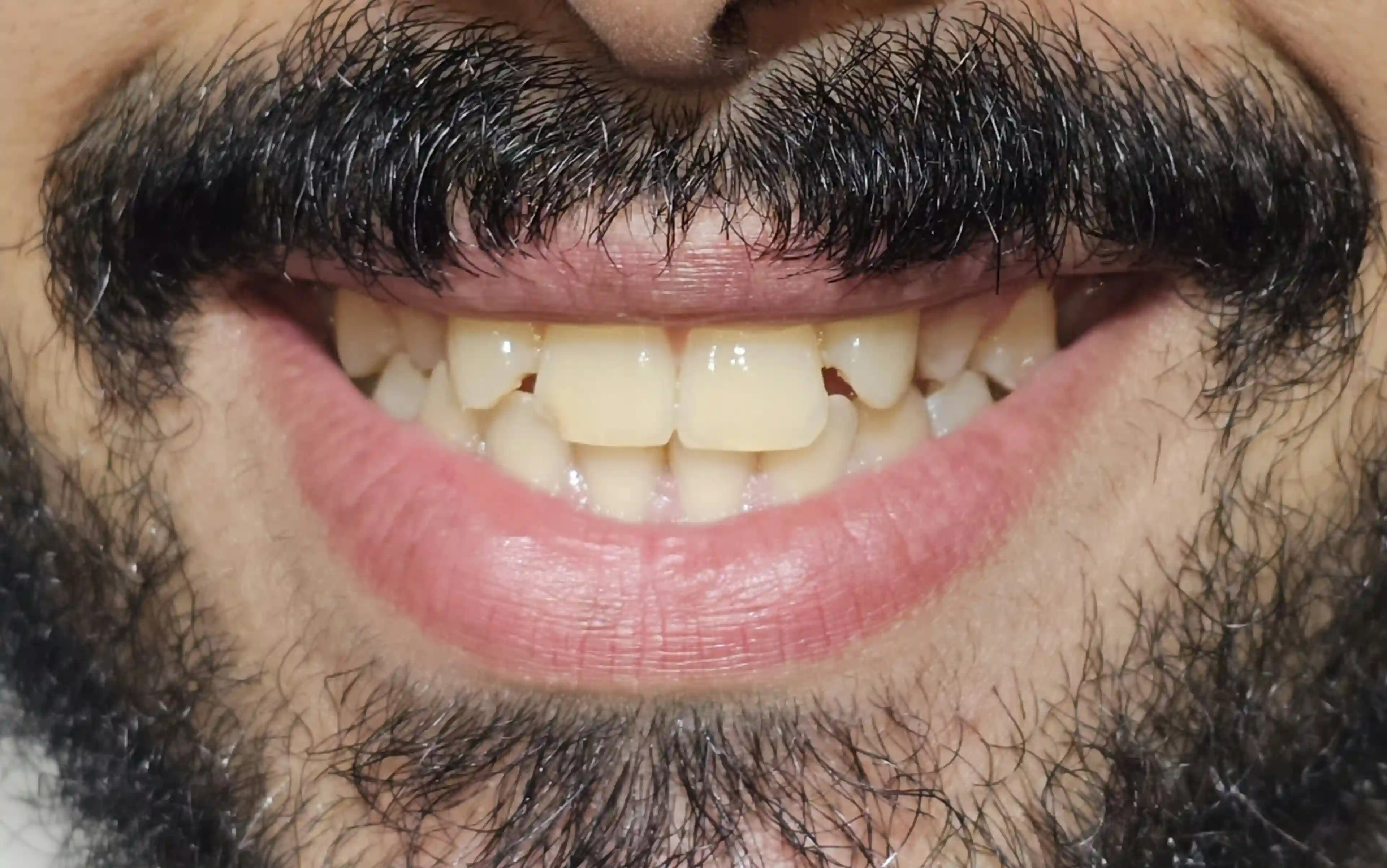 فينيرز وتجميل الأسنان - قبل