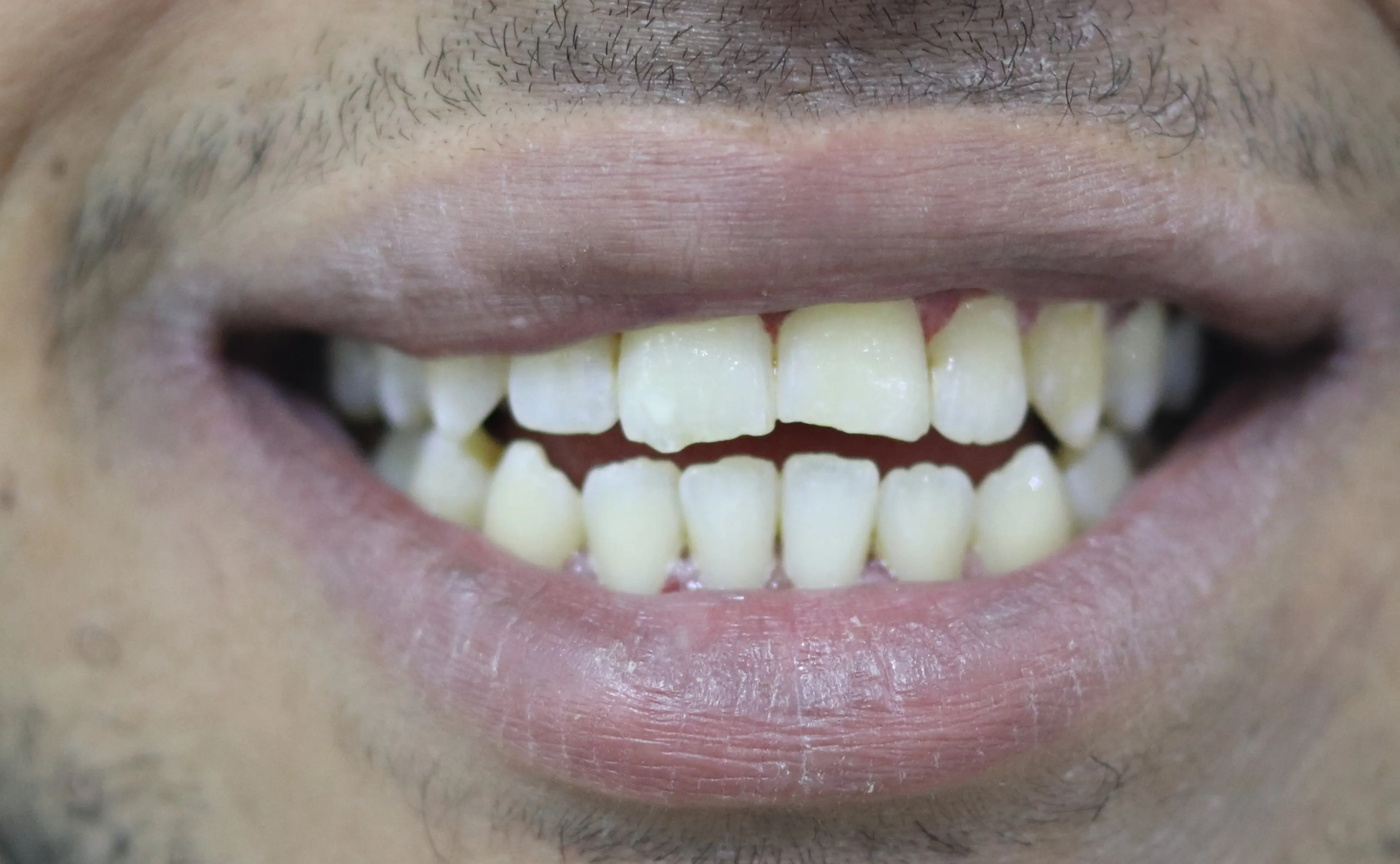 تنظيف الجير وتلميع الأسنان - بعد