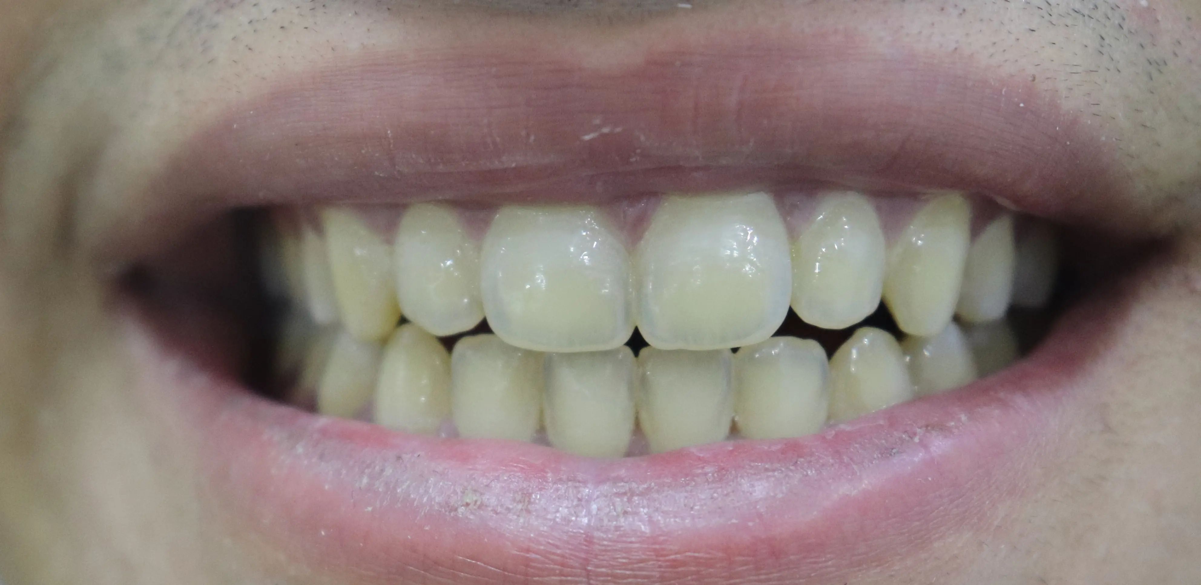 تبييض الأسنان - قبل